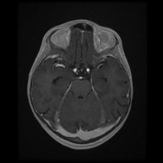 File:Cerebral and spinal tuberculosis (Radiopaedia 90489-107837 Axial T1 C+ 78).jpg