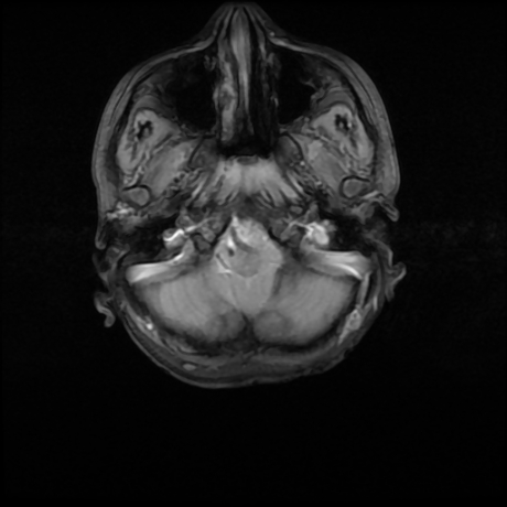 File:Cerebral and spinal tuberculosis (Radiopaedia 90489-107838 Axial T1 fat sat 1).jpg