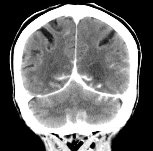 File:Cerebral aneurysm with rupture (Radiopaedia 29933-30460 Coronal non-contrast 27).jpg
