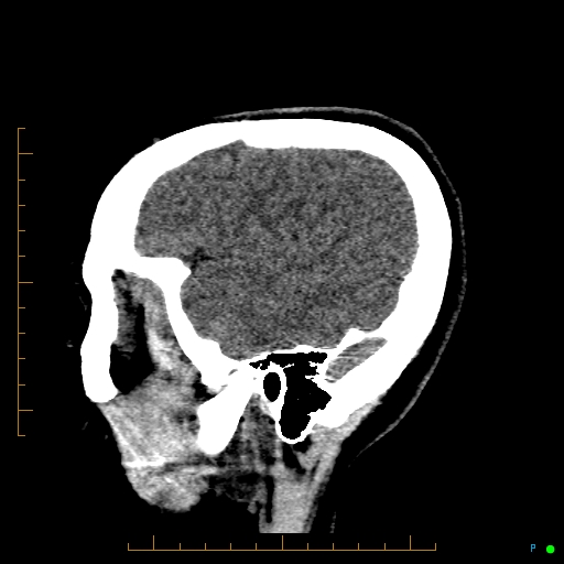 Cerebral arteriovenous malformation (AVM) (Radiopaedia 78162-90706 A 64).jpg