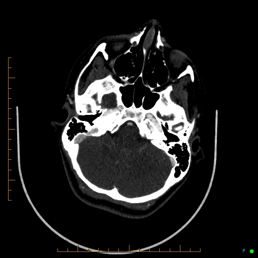 Cerebral arteriovenous malformation (AVM) (Radiopaedia 78162-90706 Axial CTA 75).jpg