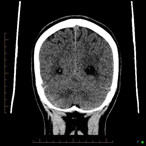 Cerebral arteriovenous malformation (AVM) (Radiopaedia 78162-90706 Coronal non-contrast 76).jpg
