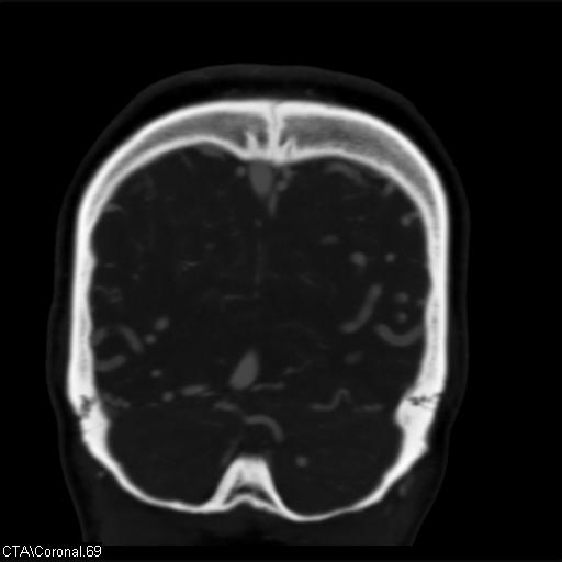 Cerebral arteriovenous malformation (Radiopaedia 28518-28759 C 69).jpg