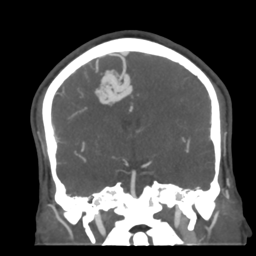 Cerebral arteriovenous malformation (Radiopaedia 39259-41505 E 33).png