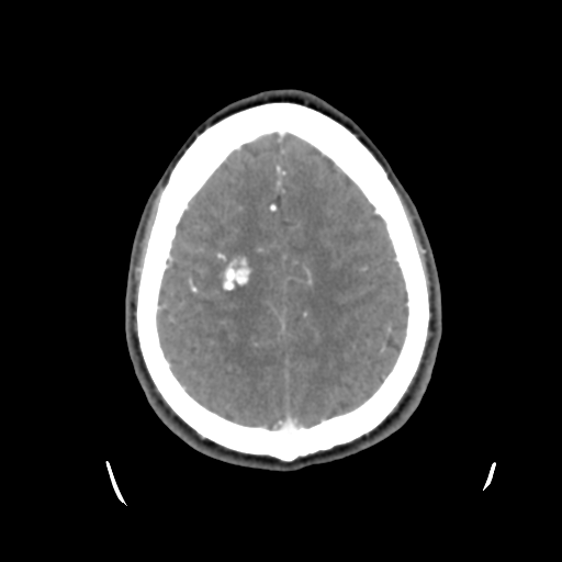 Cerebral arteriovenous malformation (Radiopaedia 55798-62371 B 40).png