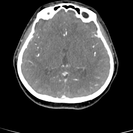 Cerebral arteriovenous malformation (Radiopaedia 73830-84645 B 51).jpg