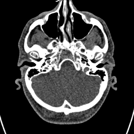 Cerebral arteriovenous malformation (Radiopaedia 78188-90746 Axial non-contrast 34).jpg