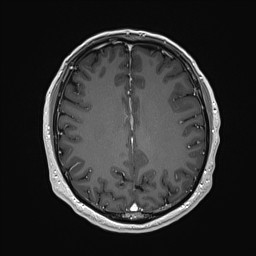 Cerebral arteriovenous malformation (Radiopaedia 84015-99245 Axial T1 C+ 104).jpg
