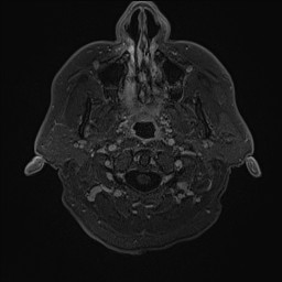 Cerebral arteriovenous malformation (Radiopaedia 84015-99245 Axial T1 C+ 7).jpg
