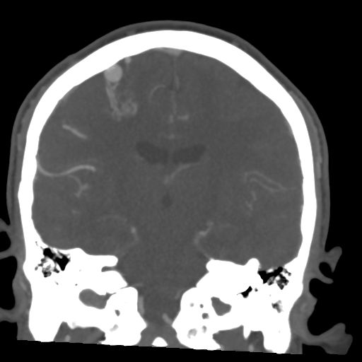 Cerebral arteriovenous malformation (Spetzler-Martin grade 2) (Radiopaedia 41262-44076 F 36).png