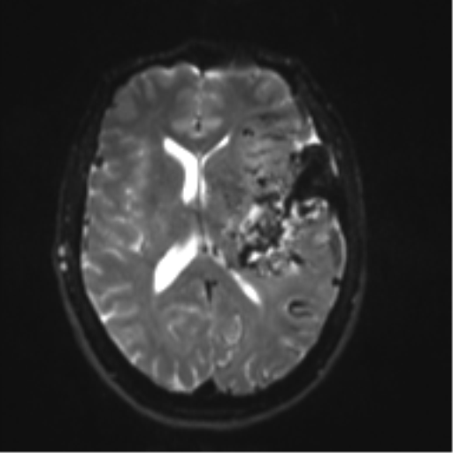 File:Cerebral arteriovenous malformation - huge (Radiopaedia 35734-37272 Axial DWI 13).png