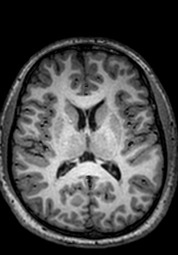 File:Cerebral arteriovenous malformation at posterior body of corpus callosum (Radiopaedia 74111-84925 Axial T1 128).jpg