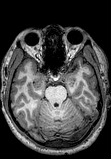 File:Cerebral arteriovenous malformation at posterior body of corpus callosum (Radiopaedia 74111-84925 Axial T1 208).jpg