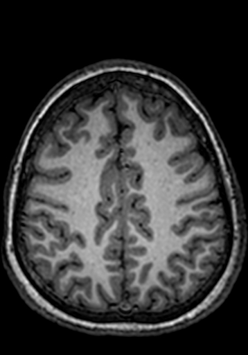 Cerebral arteriovenous malformation at posterior body of corpus callosum (Radiopaedia 74111-84925 Axial T1 70).jpg