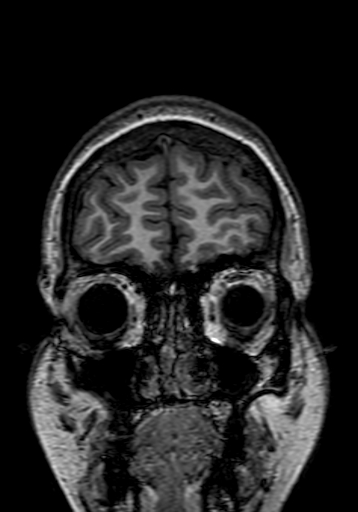 Cerebral arteriovenous malformation at posterior body of corpus callosum (Radiopaedia 74111-84925 Coronal T1 19).jpg
