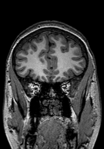 Cerebral arteriovenous malformation at posterior body of corpus callosum (Radiopaedia 74111-84925 Coronal T1 61).jpg