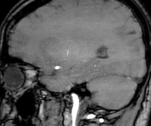 Cerebral arteriovenous malformation at posterior body of corpus callosum (Radiopaedia 74111-84925 J 282).jpg