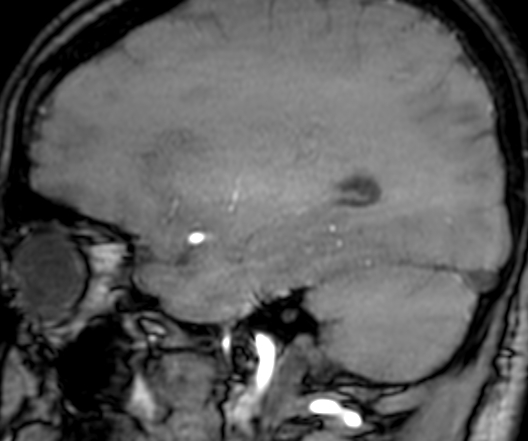 Cerebral arteriovenous malformation at posterior body of corpus callosum (Radiopaedia 74111-84925 J 286).jpg