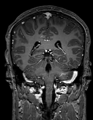 Cerebral arteriovenous malformation at posterior body of corpus callosum (Radiopaedia 74111-84925 K 240).jpg
