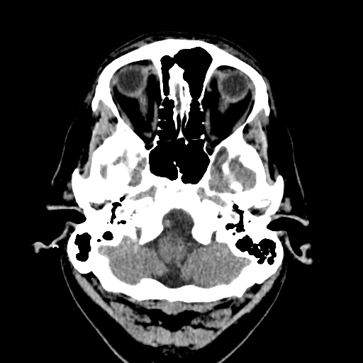 Cerebral arteriovenous malformation with lobar hemorrhage (Radiopaedia 35598-37117 Axial non-contrast 6).jpg