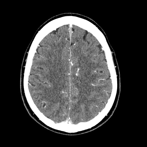 Cerebral arteriovenous malformation with lobar hemorrhage (Radiopaedia 35598-57216 A 45).jpg
