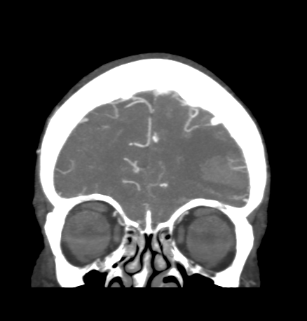 Cerebral arteriovenous malformation with lobar hemorrhage (Radiopaedia 44725-48511 B 12).png