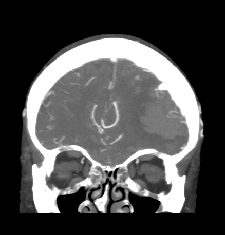 Cerebral arteriovenous malformation with lobar hemorrhage (Radiopaedia 44725-48511 B 14).png