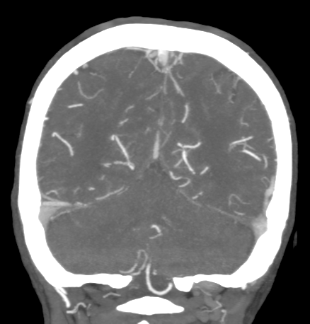 Cerebral arteriovenous malformation with lobar hemorrhage (Radiopaedia 44725-48511 B 43).png