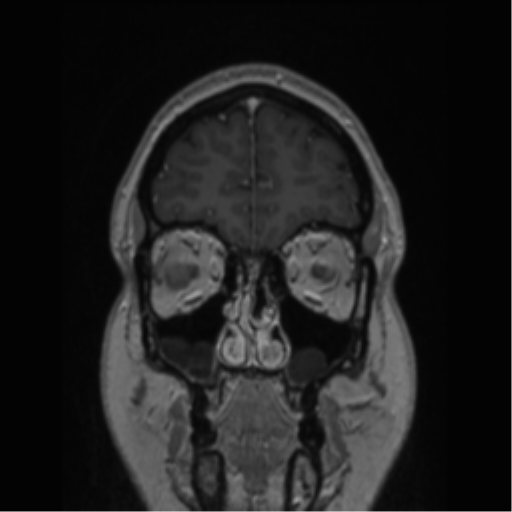 Cerebral cavernoma and development venous anomaly (Radiopaedia 37603-39482 Coronal T1 C+ 79).png