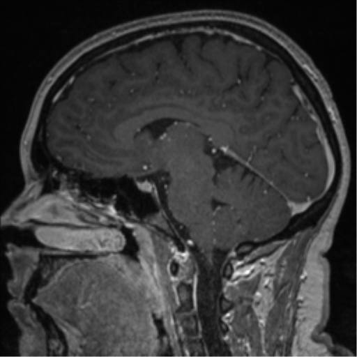File:Cerebral cavernoma and development venous anomaly (Radiopaedia 37603-39482 Sagittal T1 C+ 52).png