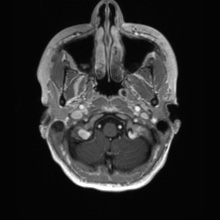 Cerebral cavernous venous malformation (Radiopaedia 70008-80021 Axial T1 C+ 4).jpg