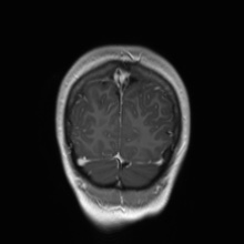 Cerebral cavernous venous malformation (Radiopaedia 70008-80021 Coronal T1 C+ 9).jpg