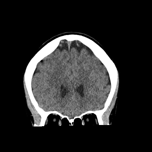 Cerebral cavernous venous malformation (Radiopaedia 70008-80022 non-contrast 21).jpg