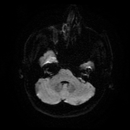 Cerebral cavernous venous malformation (Zabramski type II) (Radiopaedia 85511-101198 Axial DWI 9).jpg