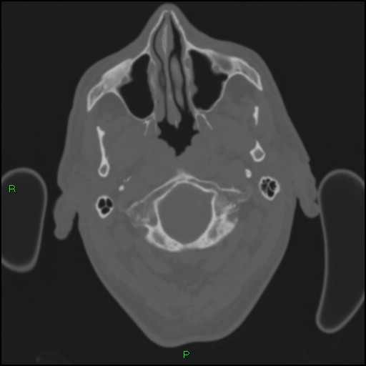 Cerebral contusions (Radiopaedia 33868-35039 Axial bone window 11).jpg