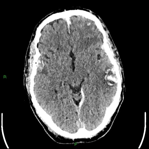 Cerebral contusions (Radiopaedia 33868-35039 Axial non-contrast 90).jpg