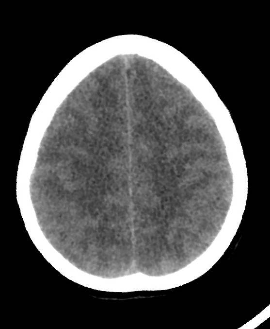 Cerebral edema due to severe hyponatremia (Radiopaedia 89826-106937 Axial non-contrast 71).jpg