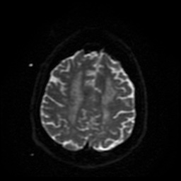 Cerebral embolic infarcts (embolic shower) (Radiopaedia 49837-55108 Axial DWI 12).jpg