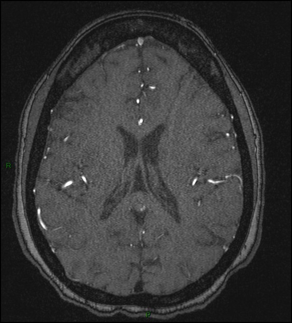 Cerebral fat embolism (Radiopaedia 35022-36525 Axial TOF 127).jpg