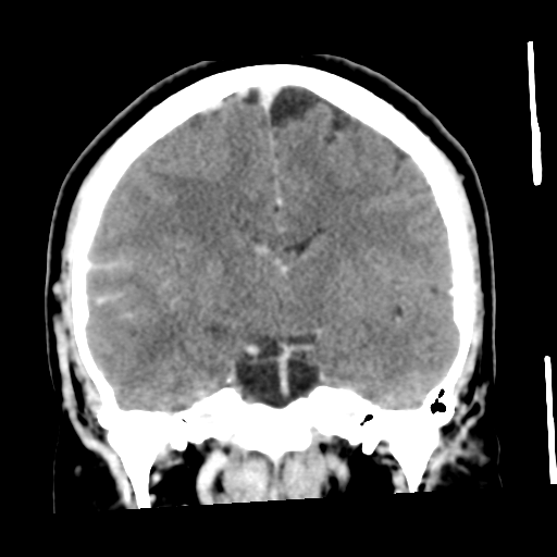 Cerebral hemorrhage secondary to arteriovenous malformation (Radiopaedia 33497-34561 C 33).png