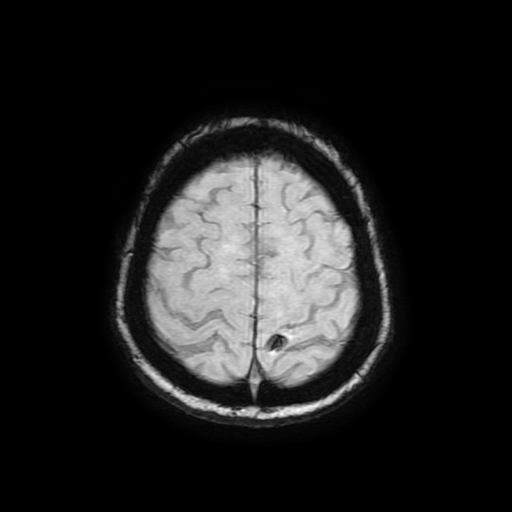 Cerebral metastases - melanoma (Radiopaedia 80972-94522 Axial SWI 83).jpg