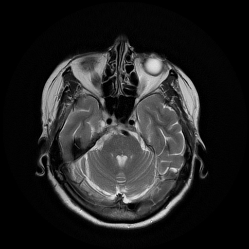 File:Cerebral metastases - melanoma (Radiopaedia 80972-94522 Axial T2 10).jpg