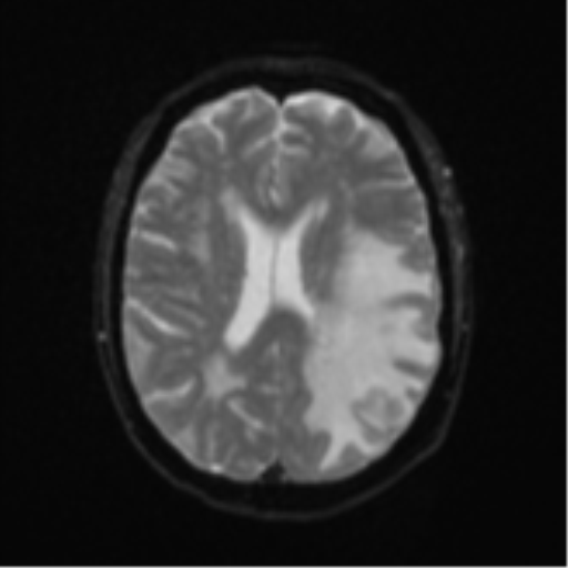 Cerebral metastasis (Radiopaedia 46744-51248 Axial DWI 17).png