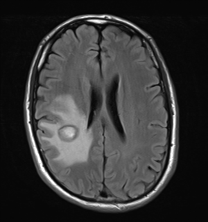 File:Cerebral metastasis - melanoma (Radiopaedia 54718-60954 Axial FLAIR 19).png