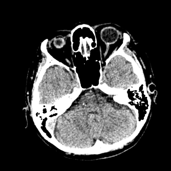 Cerebral ring enhancing lesions - cerebral metastases (Radiopaedia 44922-48818 Axial non-contrast 27).jpg