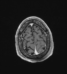 File:Cerebral toxoplasmosis (Radiopaedia 43956-47461 Axial T1 C+ 69).jpg