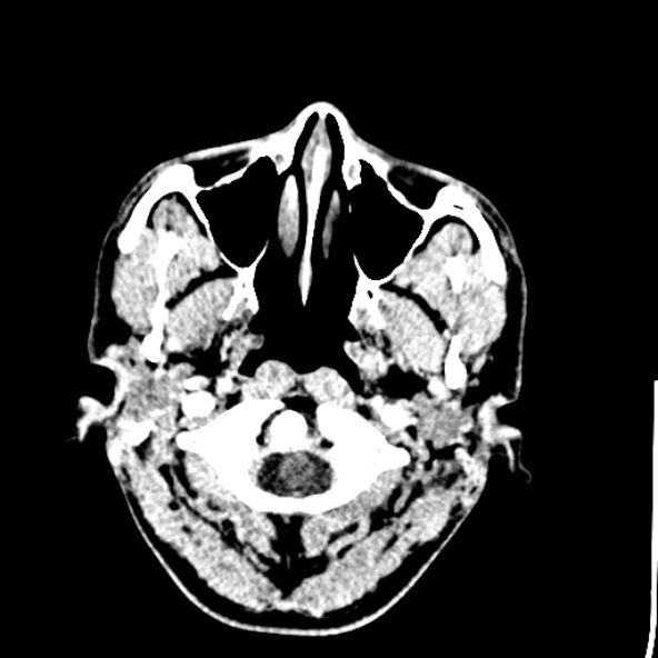 File:Cerebral toxoplasmosis (Radiopaedia 53993-60131 Axial C+ delayed 3).jpg