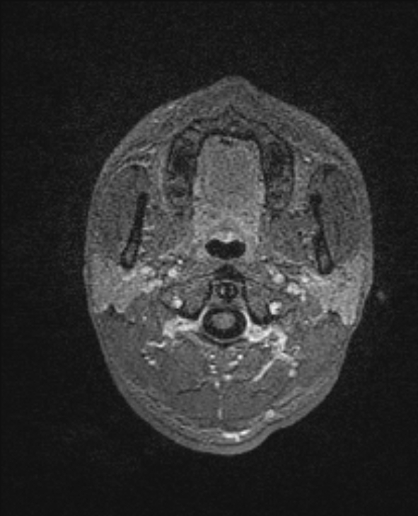 Cerebral toxoplasmosis (Radiopaedia 85779-101597 Axial T1 C+ 4).jpg