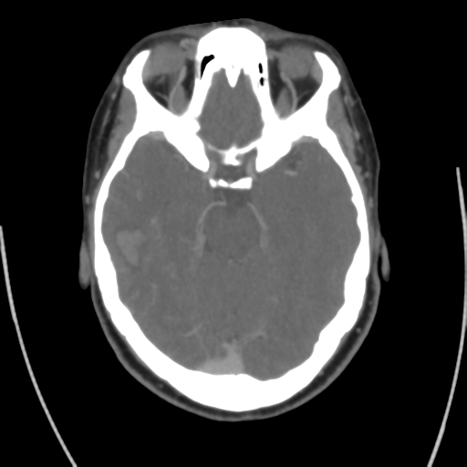 File:Cerebral venous infarct related to dural venous sinus thromboses (Radiopaedia 35292-36804 Axial C+ delayed 19).png