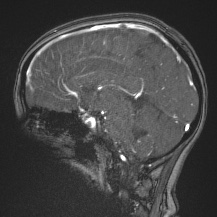 Cerebral venous infarction - hemorrhagic (Radiopaedia 81625-95505 Sagittal MRV 42).jpg